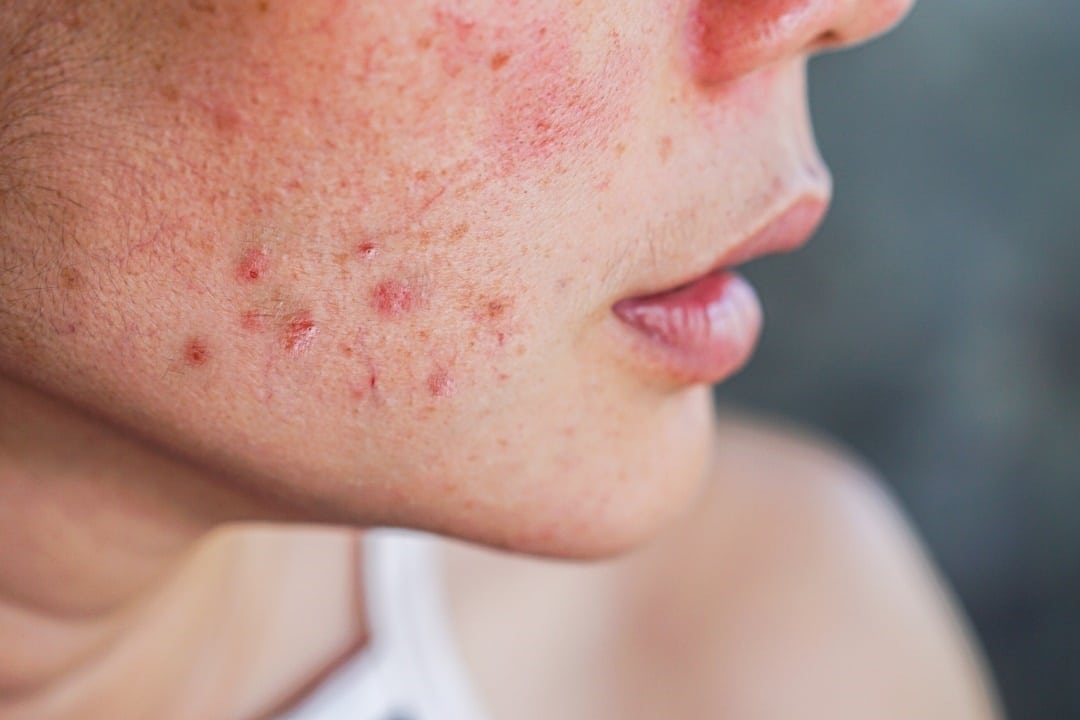 soins traiter acné sévère adulte
