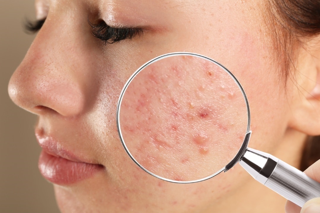 comment traiter acné sévère adolescent